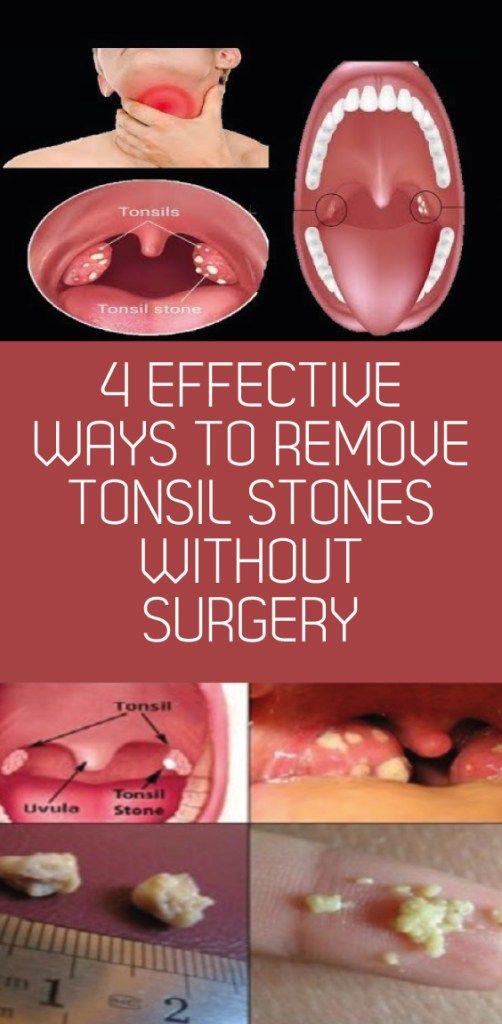 4 Effective Ways To Remove Tonsil Stones Without Surgery Healthyminer